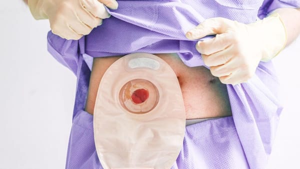 Bolehkah Pasien dengan Colostomy Terbang dengan Pesawat Komersial?
